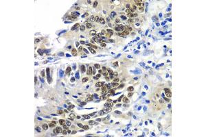 Immunohistochemistry of paraffin-embedded human colon carcinoma using DACH1 antibody (ABIN5972012) at dilution of 1/100 (40x lens). (DACH1 anticorps)
