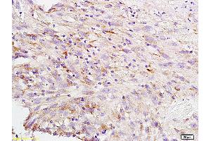 Formalin-fixed and paraffin embedded human brain glioblastoma labeled with Anti-CA II Polyclonal Antibody, Unconjugated (ABIN733298) at 1:200 followed by conjugation to the secondary antibody and DAB staining (CA2 anticorps  (AA 201-260))