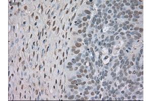 Immunohistochemical staining of paraffin-embedded Adenocarcinoma of colon tissue using anti-NTRK3mouse monoclonal antibody. (NTRK3 anticorps)