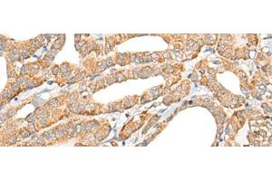 Immunohistochemistry of paraffin-embedded Human thyroid cancer tissue using CCL5 Polyclonal Antibody at dilution of 1:50(x200) (CCL5 anticorps)