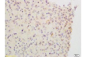 Formalin-fixed and paraffin embedded: Human brain glioma labeled with Anti-ChRM2 Polyclonal Antibody, Unconjugated  at1:200, followed by conjugation to the secondary antibody and DAB staining