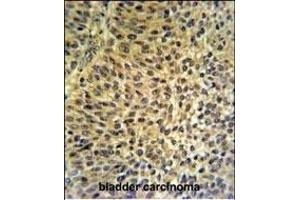 FUT6 Antibody (Center) (ABIN651118 and ABIN2840083) IHC analysis in formalin fixed and paraffin embedded bladder carcinoma followed by peroxidase conjugation of the secondary antibody and DAB staining.