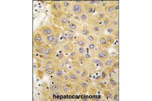Formalin-fixed and paraffin-embedded human hepatocarcinoma tissue reacted with CTGF antibody , which was peroxidase-conjugated to the secondary antibody, followed by DAB staining. (CTGF anticorps  (C-Term))