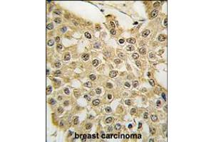 Formalin-fixed and paraffin-embedded human breast carcinoma tissue reacted with the MDM2 Antibody (S166) , which was peroxidase-conjugated to the secondary antibody, followed by DAB staining. (MDM2 anticorps  (AA 141-176))