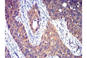 Immunohistochemical analysis of paraffin-embedded cervical cancer tissues using HTR3A mouse mAb with DAB staining.
