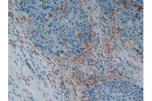 IHC-P analysis of Human Liver Cancer Tissue, with DAB staining. (Gelsolin anticorps  (AA 674-782))