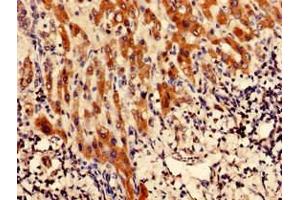 Immunohistochemistry analysis of human liver cancer using ABIN7147768 at dilution of 1:100 (CFAP61 anticorps  (AA 1-200))