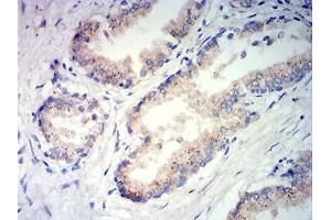 Immunohistochemical analysis of paraffin-embedded prostate tissues using PSAP mouse mAb with DAB staining. (Prosaposin anticorps  (AA 17-216))