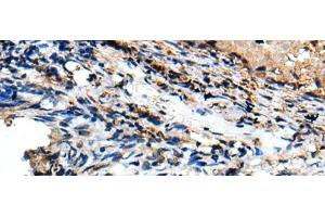 Immunohistochemistry of paraffin-embedded Human lung cancer tissue using CSRP3 Polyclonal Antibody at dilution of 1:40(x200) (CSRP3 anticorps)
