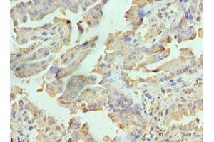 Immunohistochemistry of paraffin-embedded human lung cancer using ABIN7167113 at dilution of 1:100