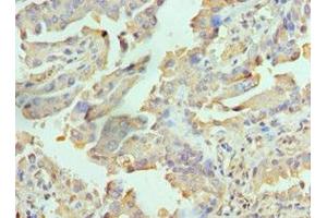 Immunohistochemistry of paraffin-embedded human lung cancer using ABIN7167113 at dilution of 1:100 (RICTOR anticorps  (AA 1-245))