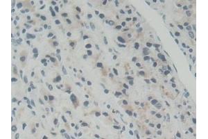 Detection of ABCB5 in Human Prostate cancer Tissue using Polyclonal Antibody to ATP Binding Cassette Transporter B5 (ABCB5)