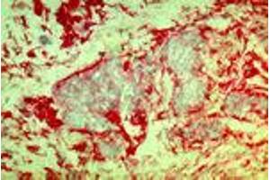 Invasive mammary carcinoma cells (MAb DF5, b1-Integrin) (ITGB1 anticorps)