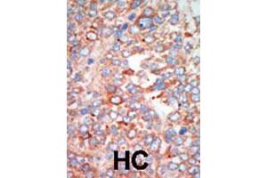 Formalin-fixed and paraffin-embedded human hepatocellular carcinoma tissue reacted with the STK24 polyclonal antibody  , which was peroxidase-conjugated to the secondary antibody, followed by AEC staining. (STK24 anticorps  (C-Term))