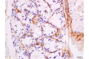 Formalin-fixed and paraffin embedded human laryngocarcinoma labeled with Anti-DNase II Polyclonal Antibody, Unconjugated  at 1:200 followed by conjugation to the secondary antibody and DAB staining. (DNASE2 anticorps  (AA 25-90))