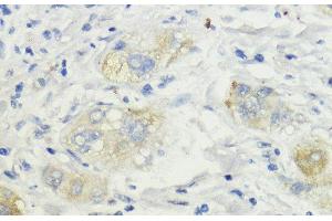 Immunohistochemistry of paraffin-embedded Human liver cancer using SURF4 Polyclonal Antibody at dilution of 1:200 (40x lens). (Surfeit 4 anticorps)