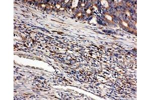 IHC-P: CD163 antibody testing of human intestinal cancer tissue (CD163 anticorps  (AA 1056-1165))