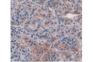 IHC-P analysis of Human Liver Cancer Tissue, with DAB staining. (GDF5 anticorps  (AA 86-501))