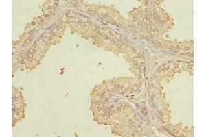 Immunohistochemistry of paraffin-embedded human prostate cancer using ABIN7164073 at dilution of 1:100 (PQLC3 anticorps  (AA 118-170))