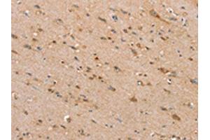 The image on the left is immunohistochemistry of paraffin-embedded Human brain tissue using ABIN7192440(SLC25A20 Antibody) at dilution 1/30, on the right is treated with synthetic peptide. (SLC25A2 anticorps)