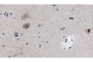 ABIN6269032 at 1/100 staining Human brain cancer tissue by IHC-P.