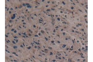 Detection of GARS in Human Prostate cancer Tissue using Polyclonal Antibody to Glycyl tRNA Synthetase (GARS)