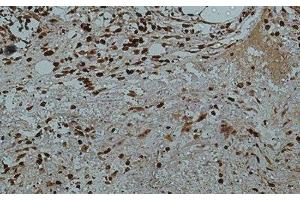 Immunohistochemistry of paraffin-embedded Human colon tissue using Galectin 3 Monoclonal Antibody at dilution of 1:50.