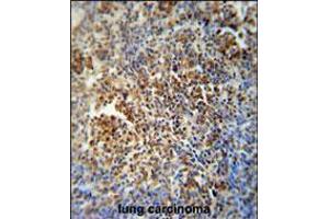 MAF1 antibody immunohistochemistry analysis in formalin fixed and paraffin embedded human lung carcinoma followed by peroxidase conjugation of the secondary antibody and DAB staining. (MAF1 anticorps  (AA 90-117))