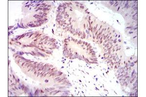 Immunohistochemical analysis of paraffin-embedded rectum cancer tissues using YAP1 mouse mAb with DAB staining.