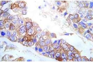Immunohistochemistry analysis of Fyn antibody pTyr530 in paraffin-embedded Human breast carcinoma tissue. (FYN anticorps  (pTyr530))