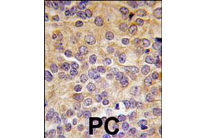 Formalin-fixed and paraffin-embedded human prostate carcinoma tissue reacted with PRMT3 polyclonal antibody  , which was peroxidase-conjugated to the secondary antibody, followed by DAB staining. (PRMT3 anticorps  (N-Term))