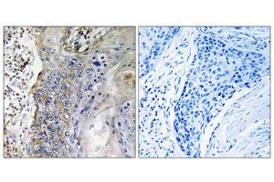 Immunohistochemistry analysis of paraffin-embedded human lung carcinoma tissue, using SLC28A2 antibody.