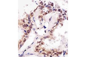(ABIN387785 and ABIN2838022) staining SUMO1 in human lung adenocarcinoma tissue sections by Immunohistochemistry (IHC-P - paraformaldehyde-fixed, paraffin-embedded sections). (SUMO1 anticorps)