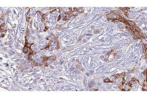ABIN6277346 at 1/100 staining Human urothelial cancer tissue by IHC-P. (SLC18A2 anticorps  (C-Term))