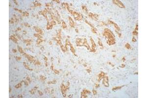 Immunohistochemistry (IHC) staining of Mouse prostate adenocarcinoma tissue, diluted at 1:200. (AMACR anticorps)