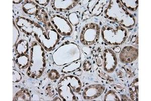 Immunohistochemical staining of paraffin-embedded Carcinoma of liver tissue using anti-NME4 mouse monoclonal antibody. (NME4 anticorps)