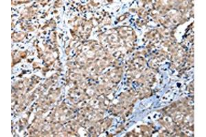 The image on the left is immunohistochemistry of paraffin-embedded Human breast cancer tissue using ABIN7131603(WDR4 Antibody) at dilution 1/30, on the right is treated with fusion protein.
