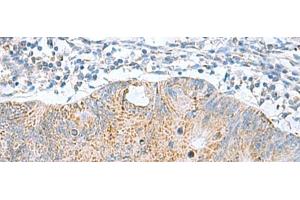 Immunohistochemistry of paraffin-embedded Human colorectal cancer tissue using GCSH Polyclonal Antibody at dilution of 1:60(x200) (GCSH anticorps)