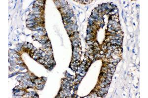 Anti- MAOA Picoband antibody,IHC(P) IHC(P): Human Intestinal Cancer Tissue (Monoamine Oxidase A anticorps  (C-Term))