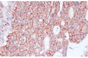 Immunohistochemistry of paraffin-embedded Human colon carcinoma using RPL30 Polyclonal Antibody at dilution of 1:100 (40x lens).