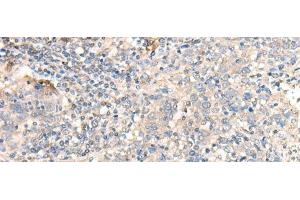 Immunohistochemistry of paraffin-embedded Human cervical cancer tissue using PARS2 Polyclonal Antibody at dilution of 1:30(x200) (PARS2 anticorps)