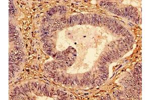 Immunohistochemistry of paraffin-embedded human colon cancer using ABIN7147346 at dilution of 1:100
