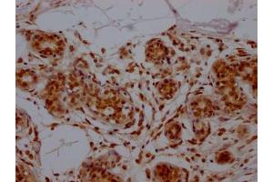 IHC image of ABIN7127462 diluted at 1:100 and staining in paraffin-embedded human breast cancer performed on a Leica BondTM system.