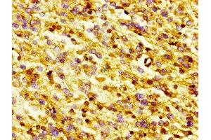 IHC image of ABIN7153749 diluted at 1:300 and staining in paraffin-embedded human glioma performed on a Leica BondTM system.