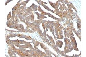 Formalin-fixed, paraffin-embedded human ovarian carcinoma stained with GnRH Receptor antibody (F1G4) (GNRHR anticorps  (AA 1-29))