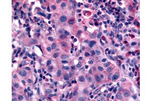 Anti-NANP antibody IHC of human Breast, Carcinoma. (NANP anticorps  (N-Term))
