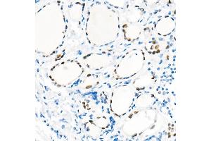 Immunohistochemistry of paraffin-embedded Human thyroid using TTF1 antibody (ABIN1679475, ABIN3017648, ABIN3017649 and ABIN7101514) at dilution of 1:1000 (40x lens).
