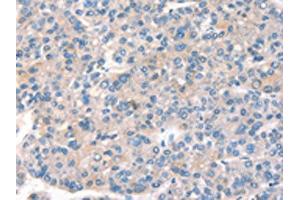 The image on the left is immunohistochemistry of paraffin-embedded Human liver cancer tissue using ABIN7191162(KCNB1 Antibody) at dilution 1/40, on the right is treated with synthetic peptide.