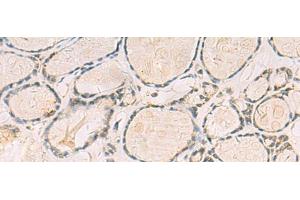 Immunohistochemistry of paraffin-embedded Human thyroid cancer tissue using TCAP Polyclonal Antibody at dilution of 1:55(x200) (TCAP anticorps)