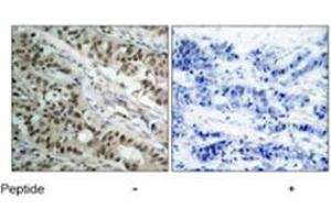 Immunohistochemical analysis of paraffin-embedded human breast carcinoma tissue using FOXO1 polyclonal antibody  .